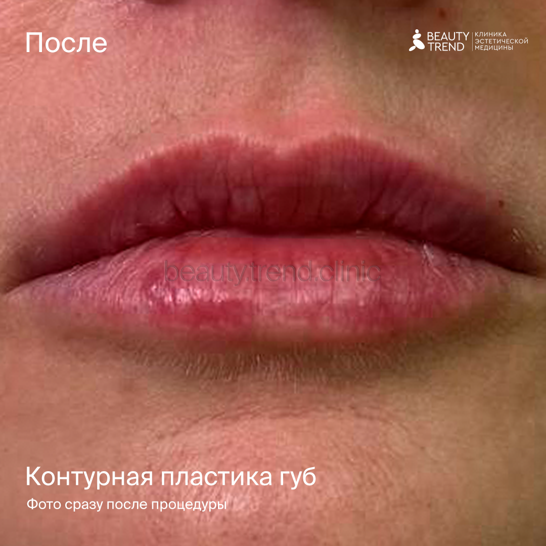 Контурная пластика губ - после 1